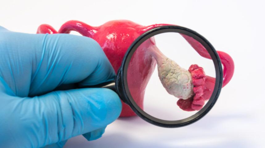 Yumurtalık kistleri her zaman operasyon gerektirmez