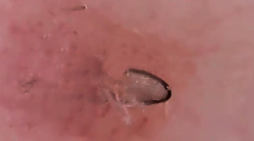 Önce batık kıl,  daha sonra sivilceden kurtulma yöntemi şaşkına çevirdi