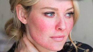 Pityriasis rosea nedir, belritileri nelerdir? pityriasis rosea hastalığının tedavisi nasıl yapılır?