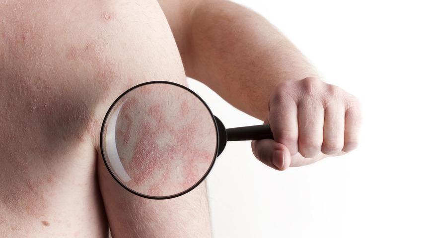 Egzama nedir? Egzama vücutta neleri etkiler? 