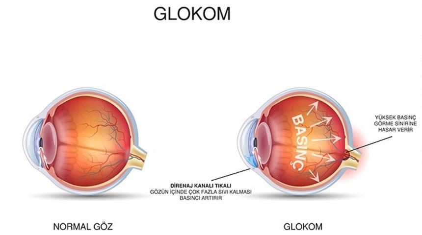 40 yaş sonrası g&ouml;z tansiyonuna dikkat
