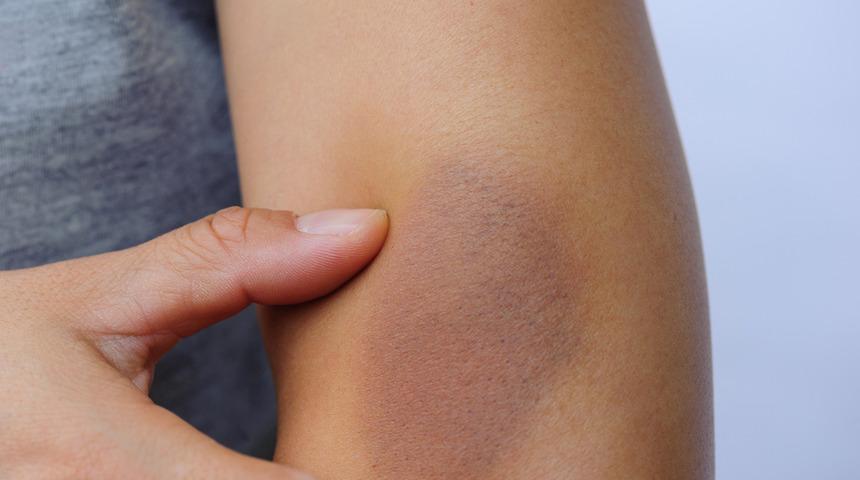 Takayasu hastalığı nedir? Sebepsiz yere kolunuz morarıyor ve çabuk yoruluyorsanız dikkat!