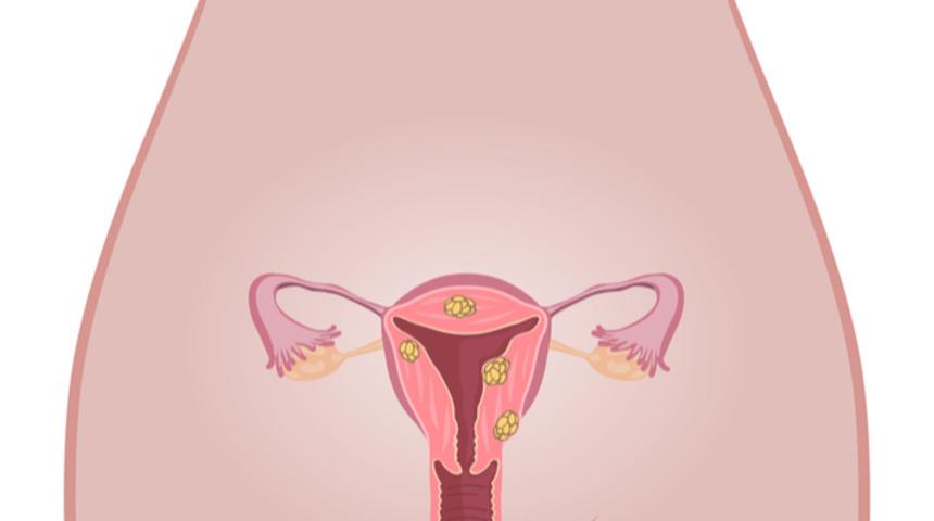 Miyom belirtileri nelerdir, tanısı nasıl konur?