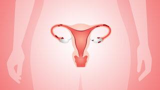 Çikolata kisti embriyonun tutunmasını engeller mi?