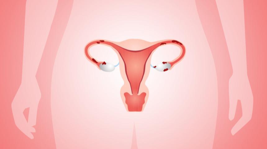 Çikolata kisti embriyonun tutunmasını engeller mi?