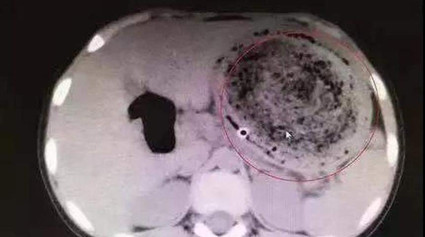 Karın ağrısıyla hastaneye kaldırılan küçük kız doktorları şoke etti!