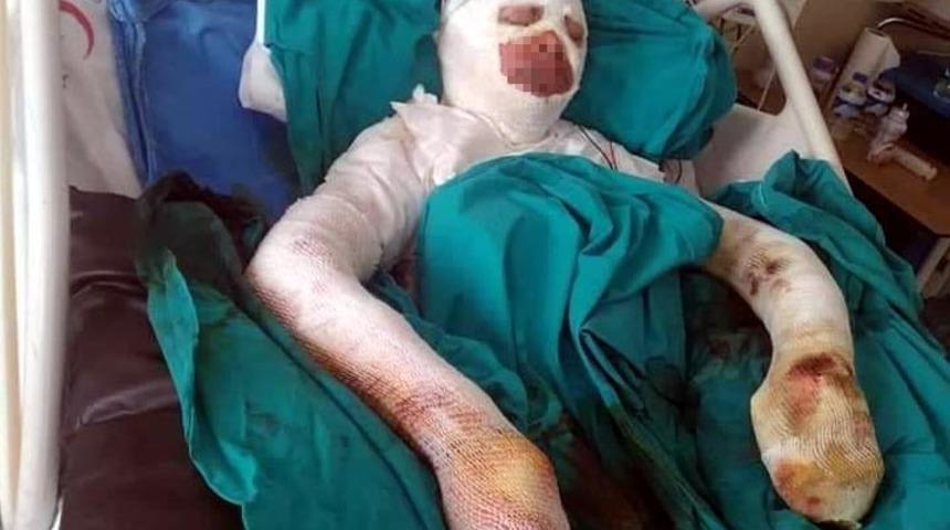 Liseli Gözde, bitlenen saçlarını benzinle yıkamak isterken kendini yaktı