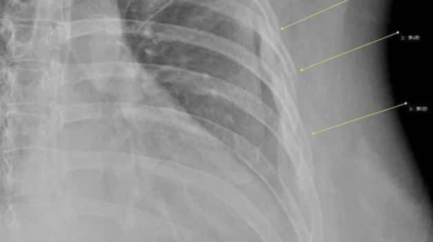 G&uuml;nde 10 bardak t&uuml;ketti! Neredeyse t&uuml;m kemikleri eridi