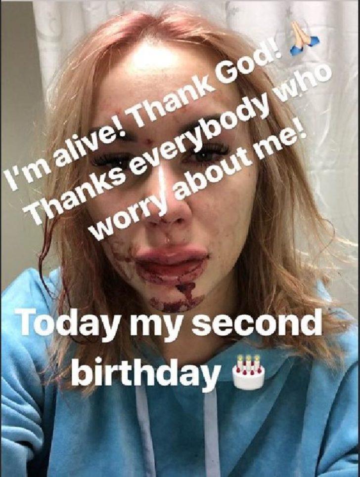 Mykola Morozyuk'un kaza geçiren eşi Iryna Morozyuk'un son hali G4