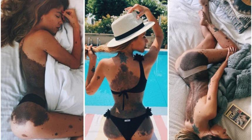 Yıllarca 'dalma&ccedil;yalı' damgası yedi, şimdi &ouml;vg&uuml; dolu yorumlar alıyor! Gen&ccedil; kızın mesajı olduk&ccedil;a net: 'Kendinize g&uuml;venin'