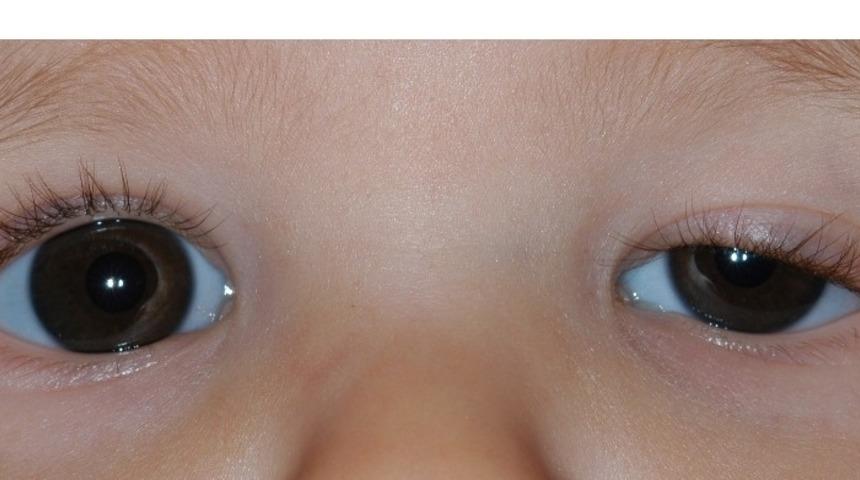 &Ccedil;ocuklarda g&ouml;z kapağı d&uuml;ş&uuml;kl&uuml;ğ&uuml; &ouml;nemsenmeli