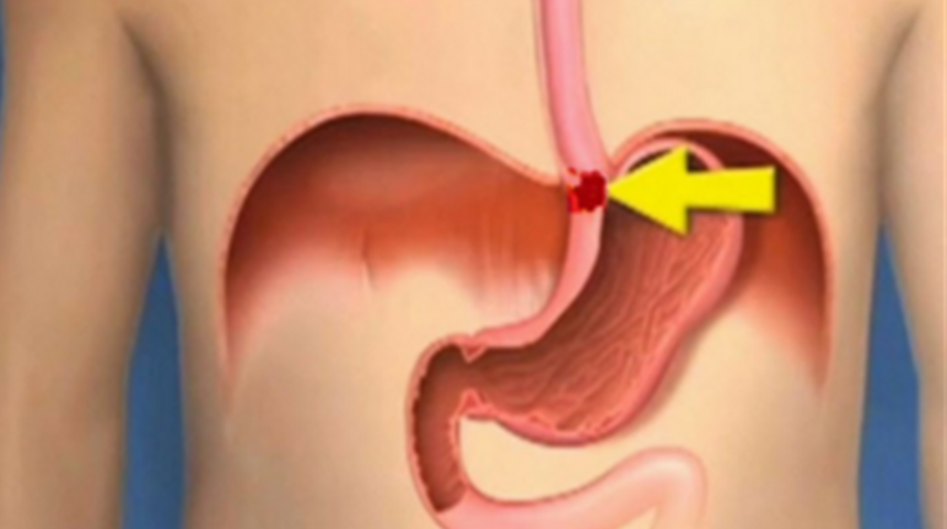 Yemek borusu kanseri belirtileri nelerdir? Yemek borusu kanseri tedavisi ile ilgili ne yapmak gerekir?