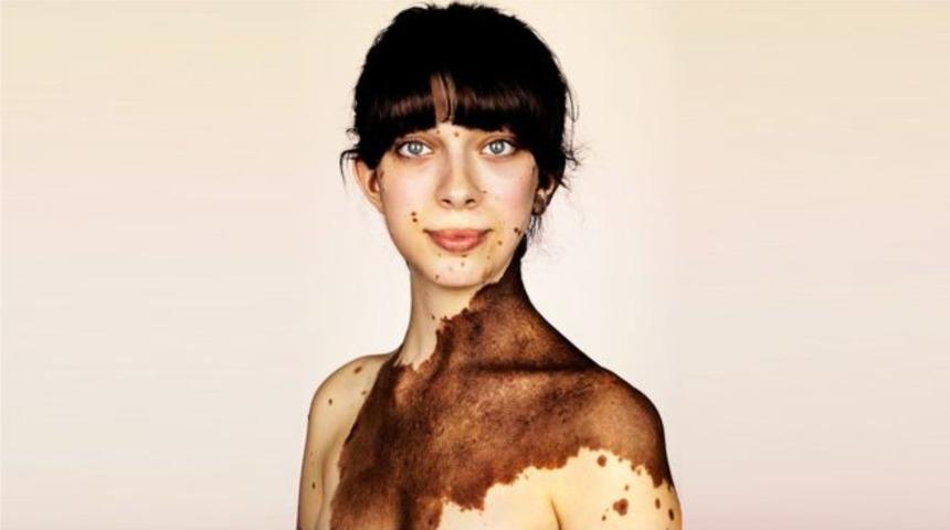 &Ccedil;ok nadir bir deri hastalığıyla d&uuml;nyaya geldiler, hastalıkları sanat oldu!