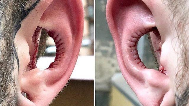 Modaya uydu! Kulağının içini ameliyatla aldırdı