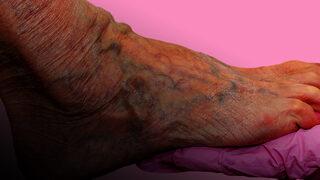 Varis tedavisine yardımcı 7 yöntem