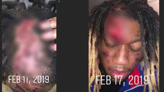 Ünlü rapçi OG Maco et yiyen bakteri kaptı! Yüzünü yemeye başladı