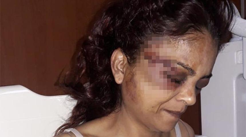 İmam nikahlı eşini bu hale getirdi! İşkenceden kurtulmak i&ccedil;in &ccedil;amaşır suyu i&ccedil;miş!