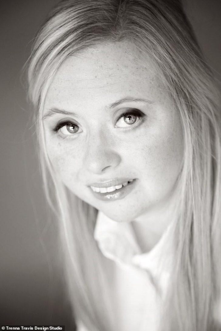 Asla normal bir hayatı olmayacağını söylediler, manken oldu G3