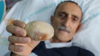 Yıllarca onunla yaşadı: Görünce patates sandım