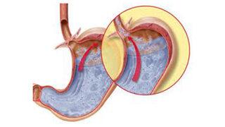 Çocuklarda akalazya nedir? Çocuklarda akalazya belirtileri nelerdir? Çocuklarda akalazya tedavisi nasıl olur? 