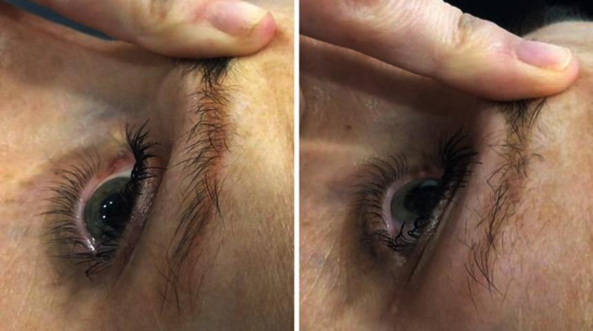 Microblading yanlış uygulandığında korkunç sonuçlara neden olabilir!