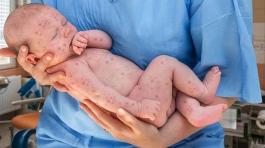 Dünyada kızamık vakaları neden artıyor?