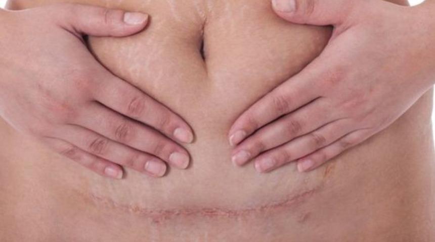 Dünya genelinde her yıl 300 bin kadın sezaryen doğum sonucu ölüyor