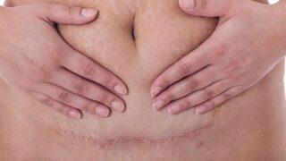 Dünya genelinde her yıl 300 bin kadın sezaryen doğum sonucu ölüyor