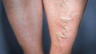 Varislere 15 dakika lokal anestezi ile müdahale