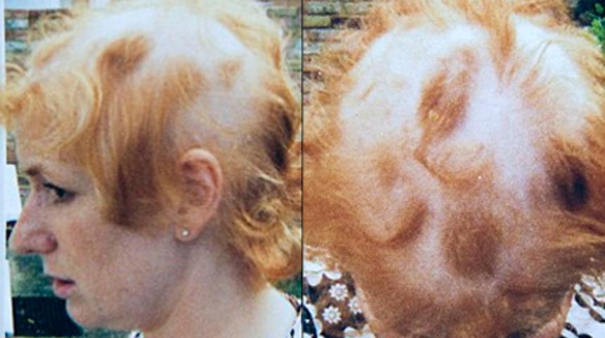 Sa&ccedil; D&ouml;k&uuml;lmesini &Ouml;nleyen Diyet