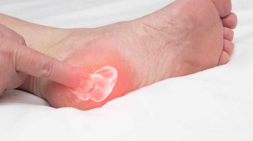 Topuk dikeni nedir, nasıl teşhis edilir? Topuk dikeni tedavisi nasıl yapılır? 