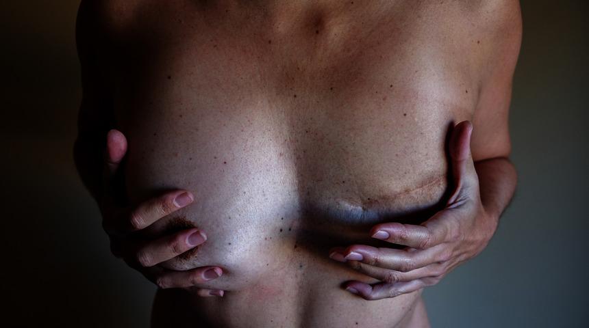 Meme kanseri öldürücü kanser tipi olmaktan çıktı!