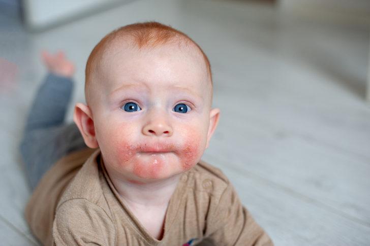 Bebeklerde atopik dermatite karşı etkili öneriler