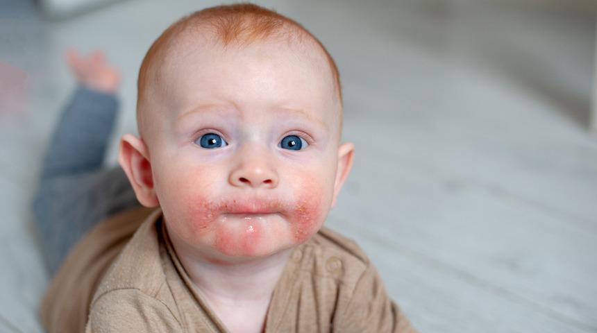 Bebeklerde atopik dermatite karşı etkili öneriler