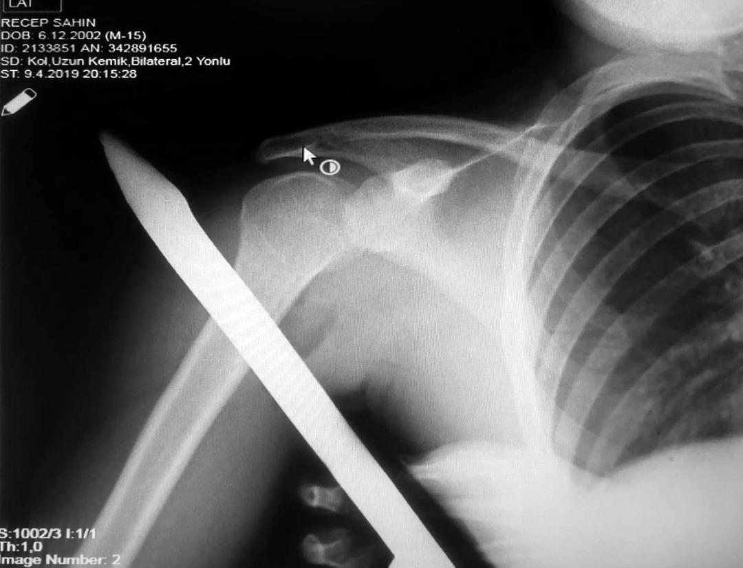 Omzuna korkuluk demiri saplandı