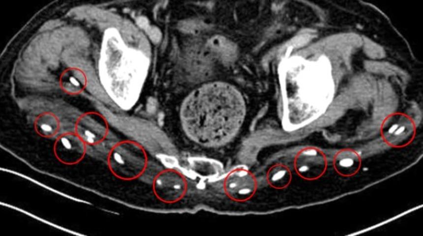 &Ccedil;iğ domuz eti yiyen adamın v&uuml;cudundan y&uuml;zlerce solucan yumurtası &ccedil;ıktı