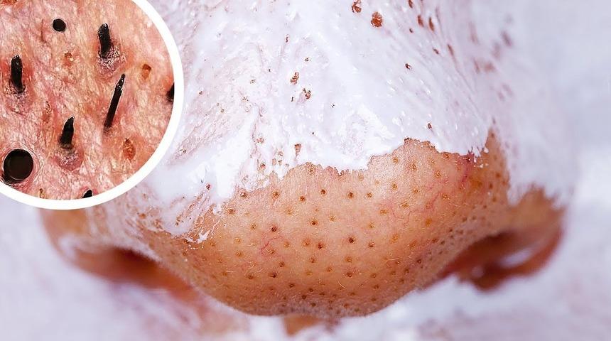 Akne, yalnızca bir cilt problemi değil!