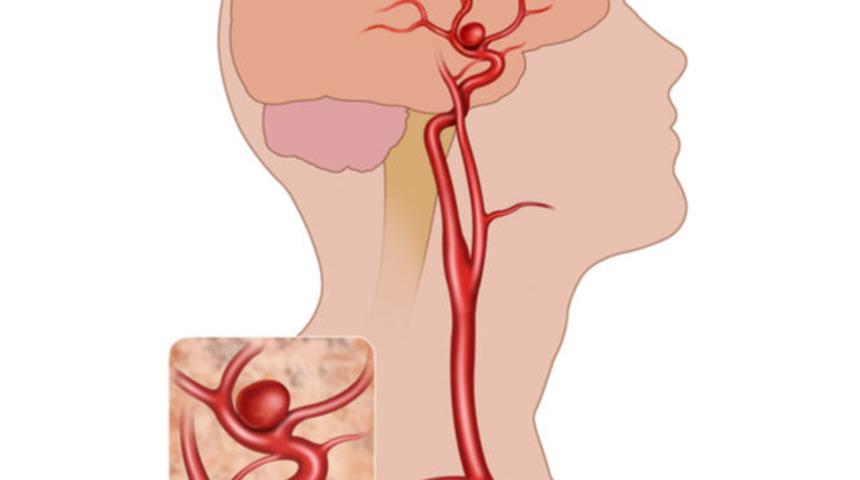 Karotis arter hastalığı hakkında ne biliyoruz?