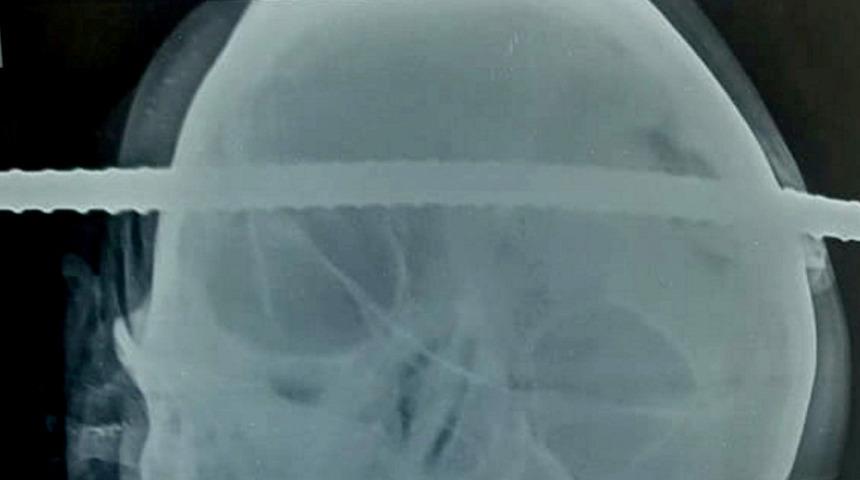 Kafatasına demir çubuk saplanan adam hayatta kaldı!