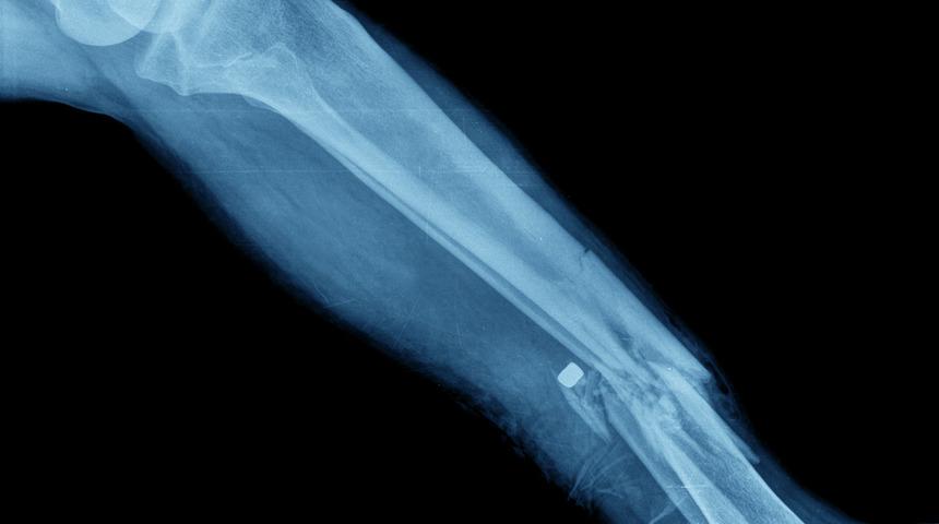 'Kemik kırarak dolandırıcılık': 34 g&ouml;zaltı