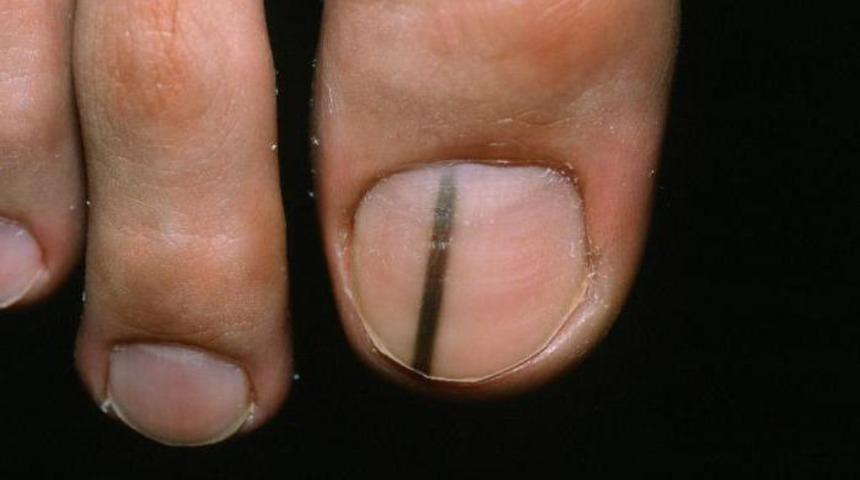 Tırnaklardaki koyu renk &ccedil;izgiler hastalık habercisi