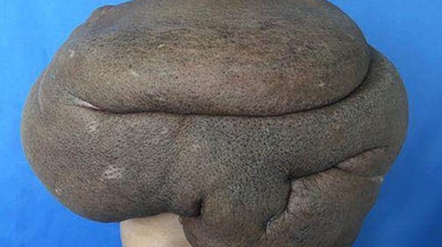 15 kiloluk tümör tüm sırtını sardı!