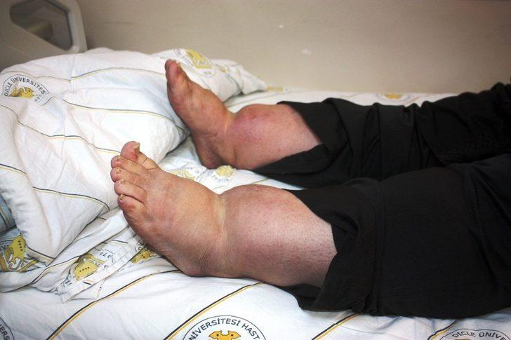 Zayıflamak isterken ölümden döndü! G2