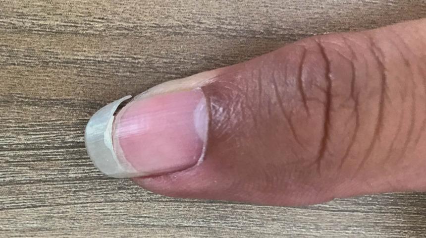 Kırılgan tırnak sendromuna yakalananlara iyi haber: Artık tırnaklarınız kırılmayacak