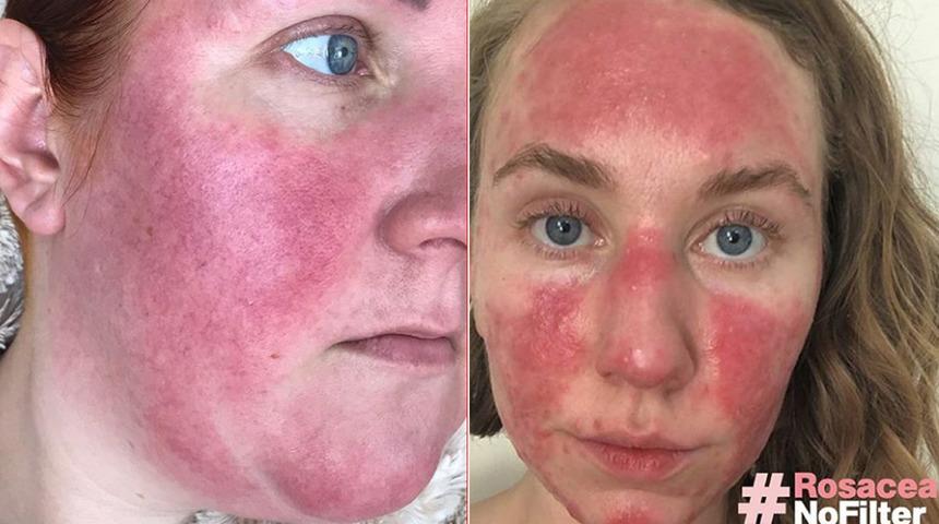 Gül hastalığıyla mücadele eden kadınlar farkındalık oluşturmak istiyor