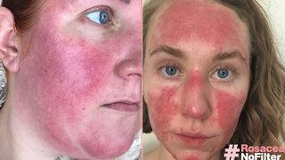 Gül hastalığıyla mücadele eden kadınlar farkındalık oluşturmak istiyor