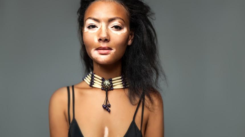 Vitiligo nedir? Vitiligo neden kaynaklanır? En güncel vitiligo tedavi yöntemleri nelerdir?