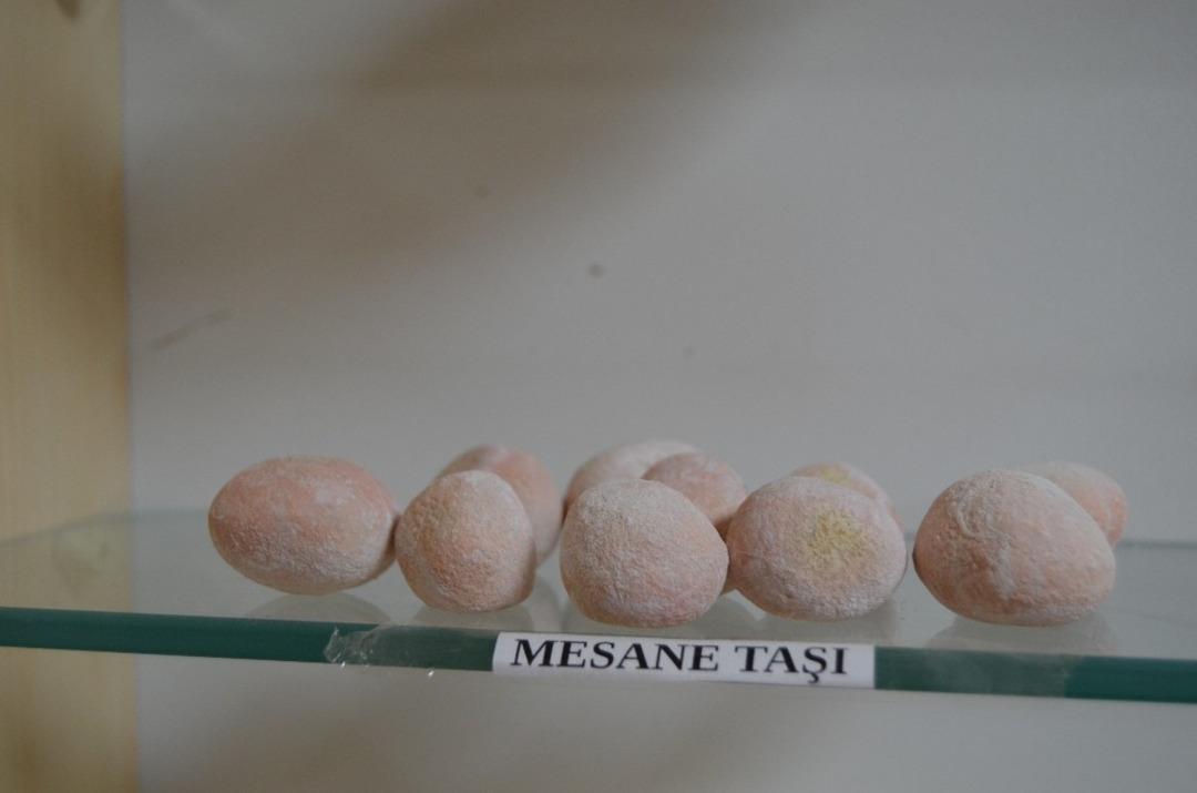 Hastalardan &ccedil;ıkarılan b&ouml;brek taşları sergileniyor