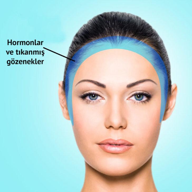 Pek umursamıyoruz ama sivilceler ayrı ayrı hastalık habercisi! G3