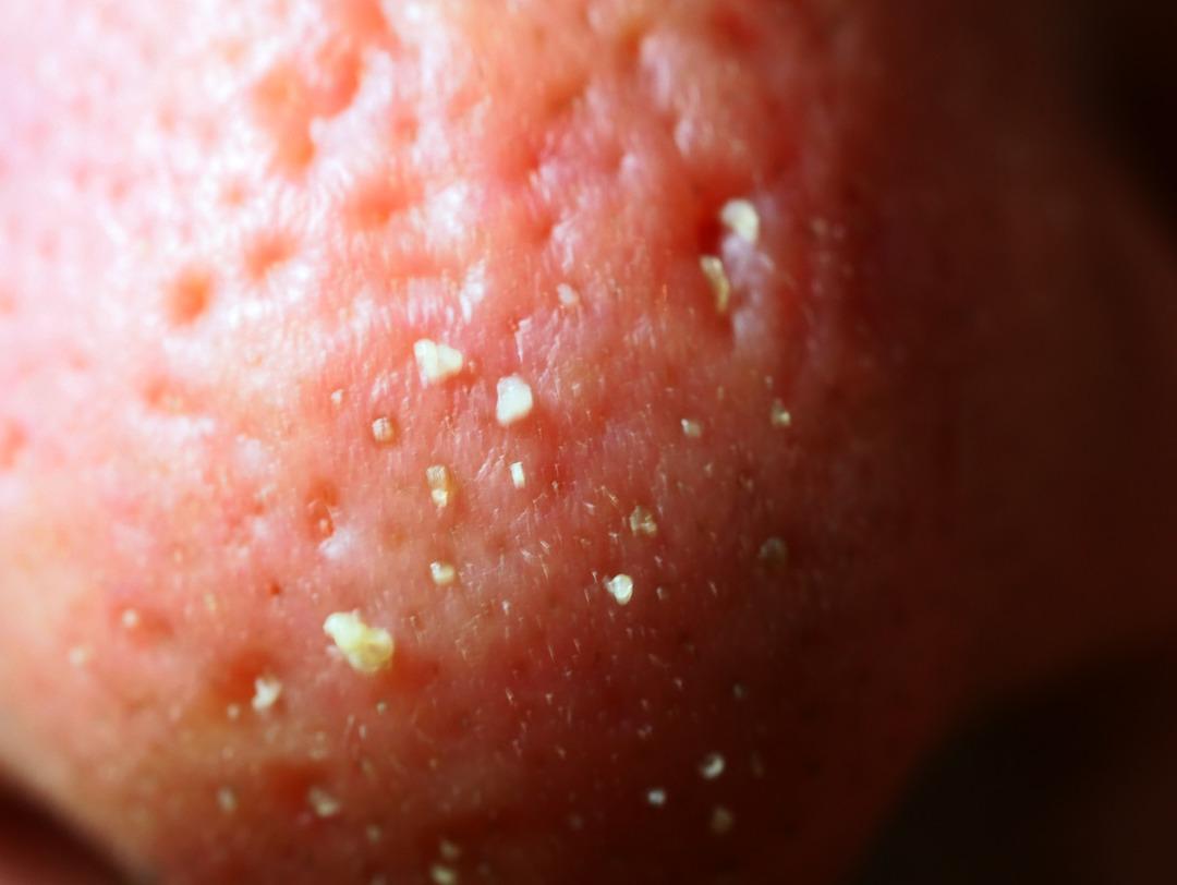 Pek umursamıyoruz ama sivilceler ayrı ayrı hastalık habercisi!